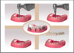 Full Mouth Dental Rehabilitation