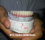 Implant supported prosthesis