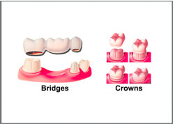 Dental Crown and Bridge Implant Clinic