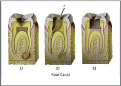 Teeth Cavity and Root Canal Treatment