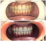 A case of Smile Design with the help of Smile Simulation software